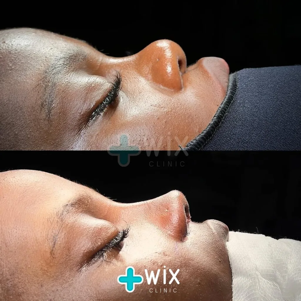 Rhinoplasty Before and After