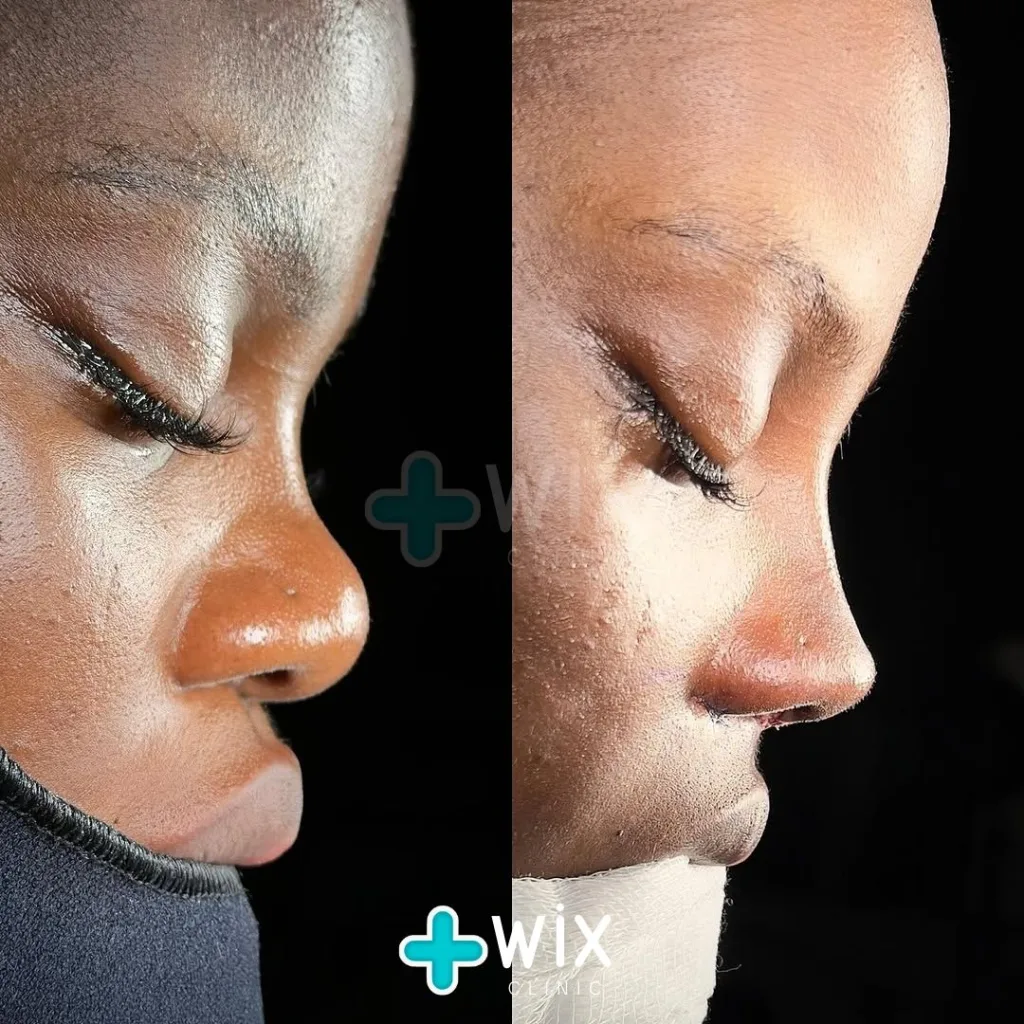 Rhinoplasty Before and After