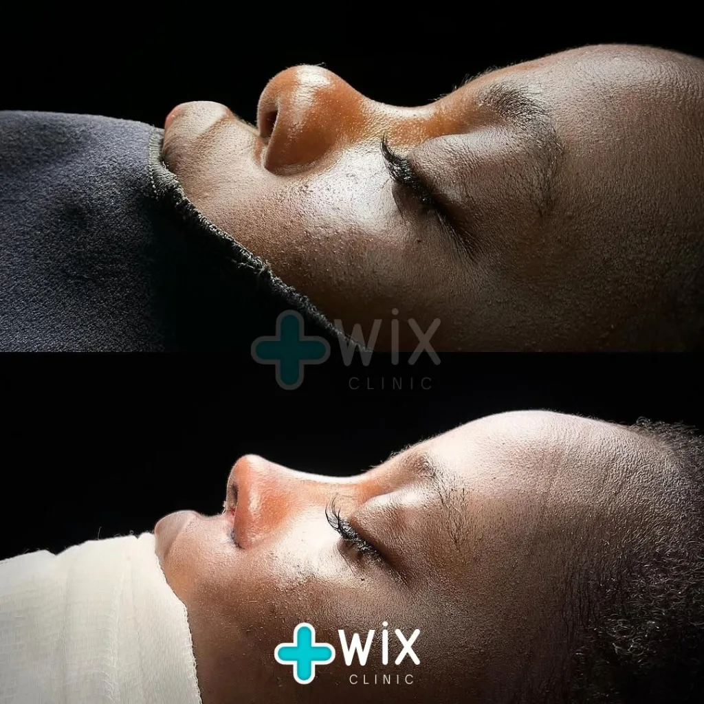 Rhinoplasty Before and After