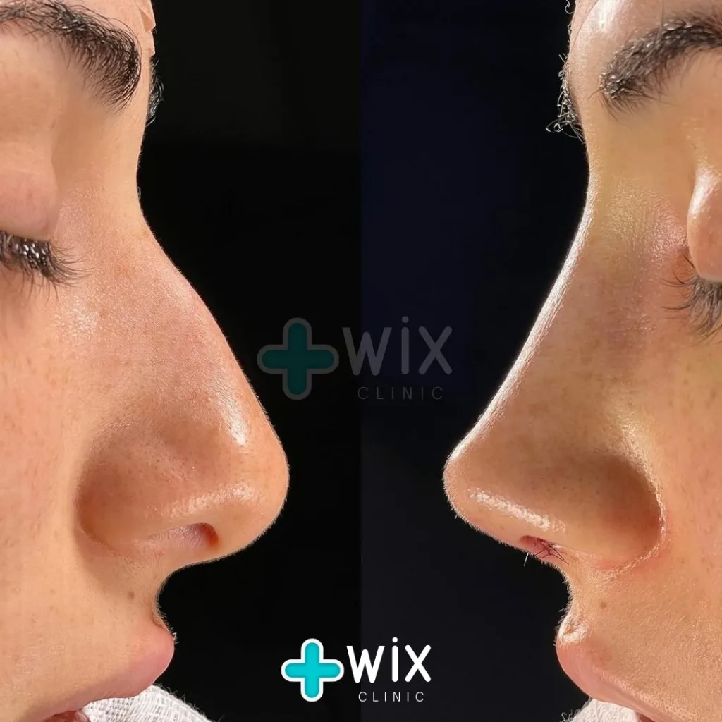 Rhinoplasty Before and After