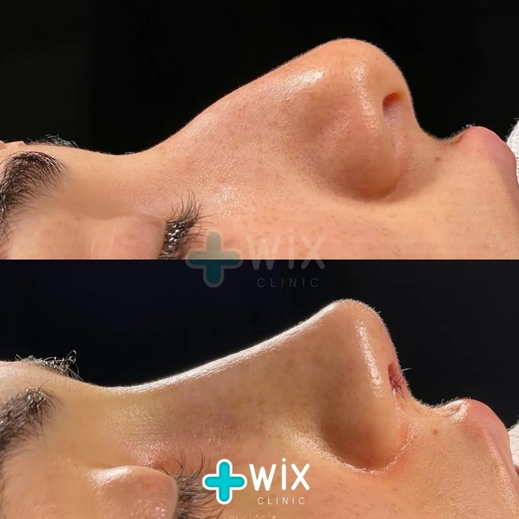 Rhinoplasty Before and After