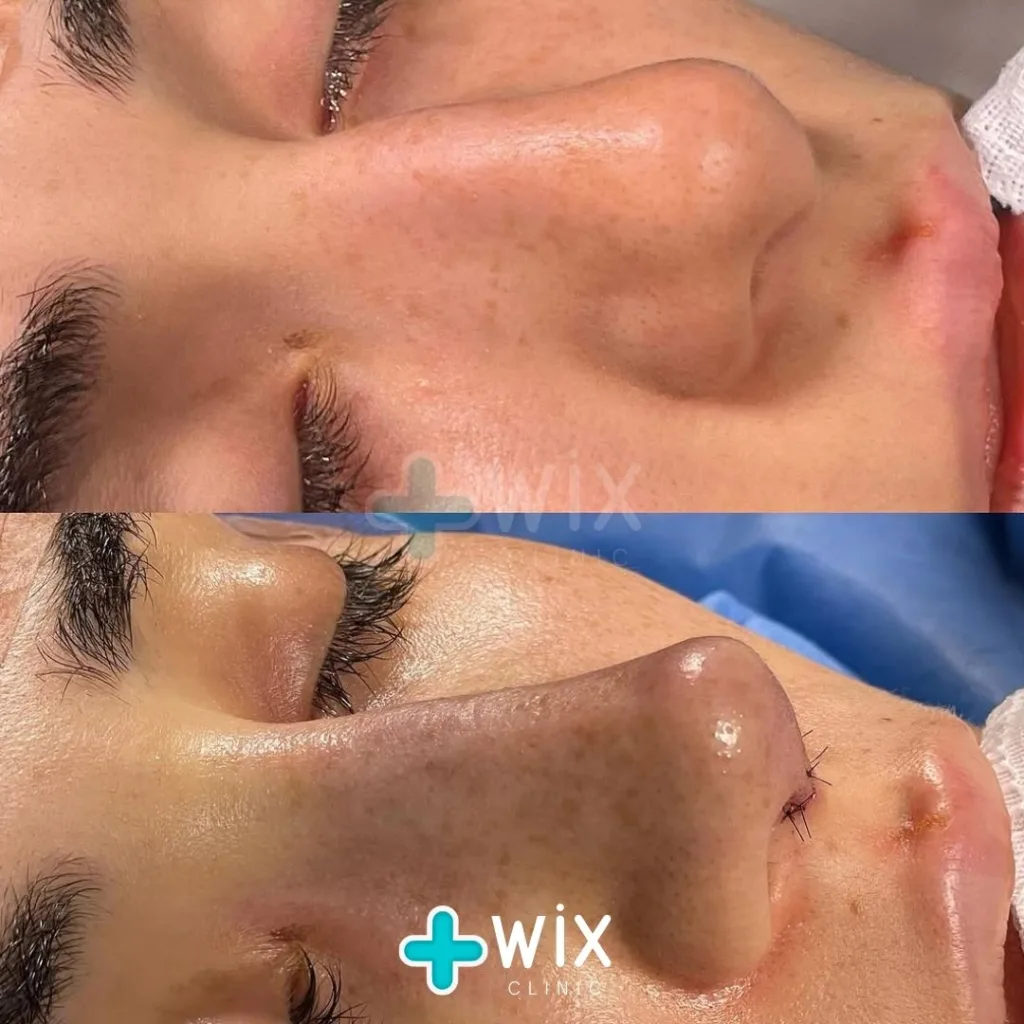 Rhinoplasty Before and After