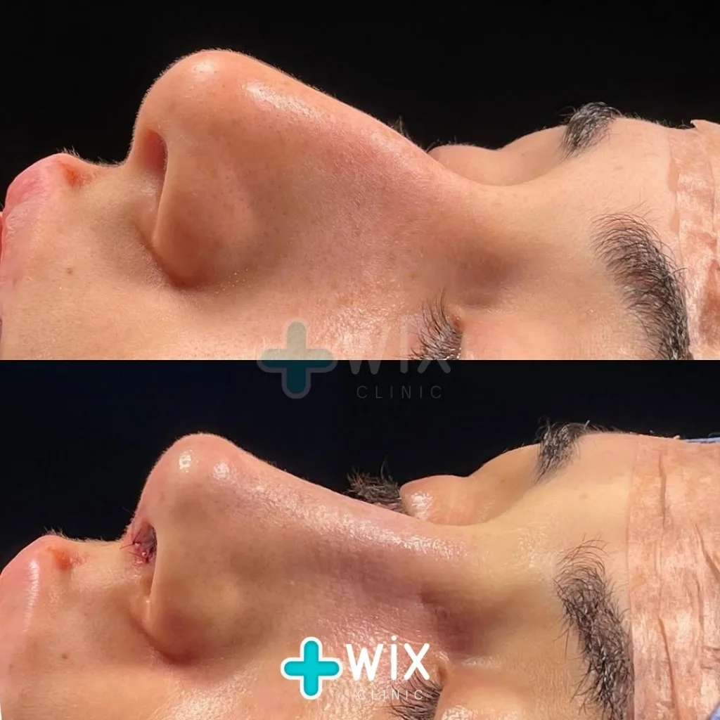 Rhinoplasty Before and After