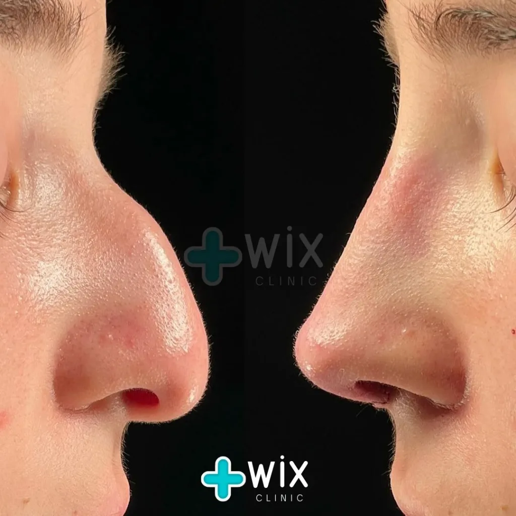 Rhinoplasty Before and After