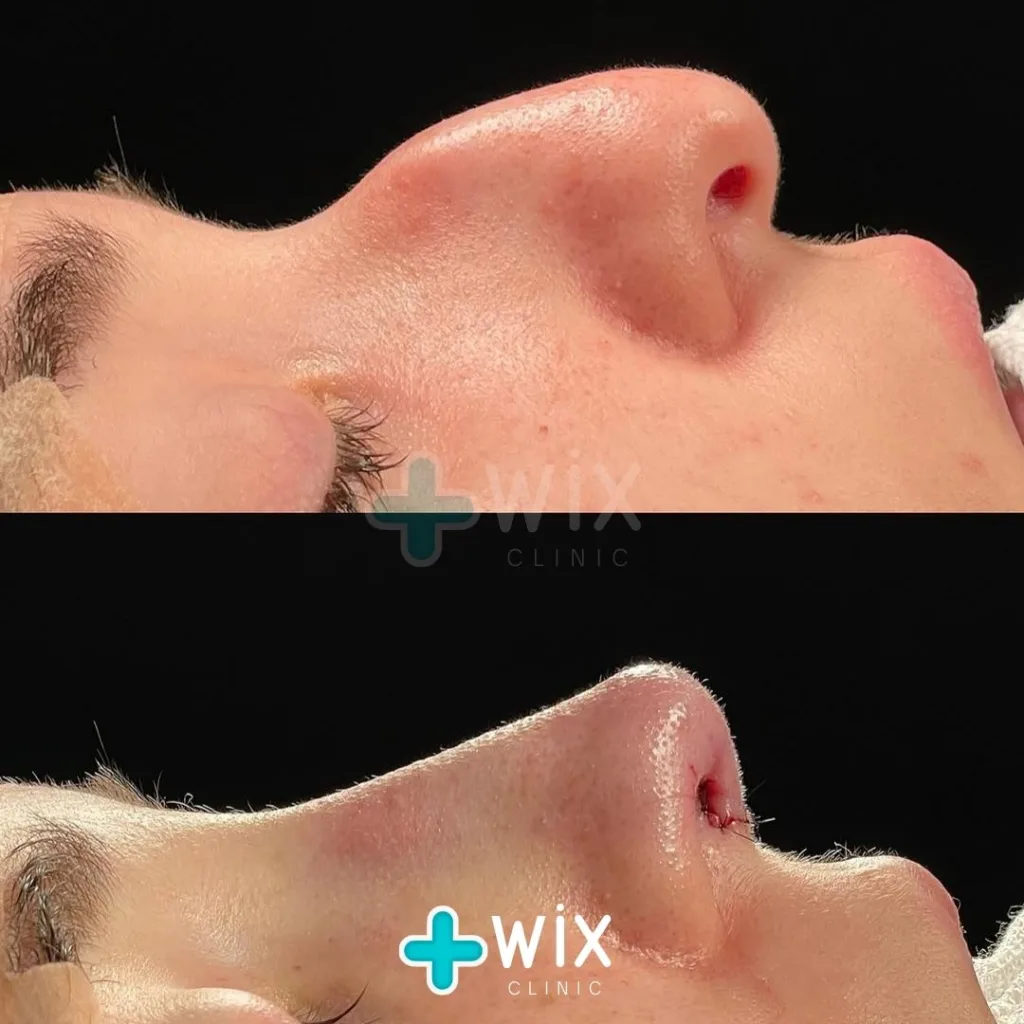 Rhinoplasty Before and After