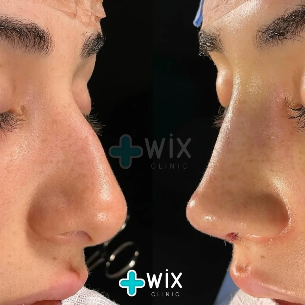 Rhinoplasty Before and After