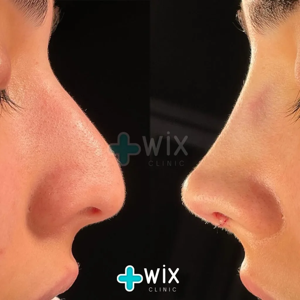 Rhinoplasty Before and After