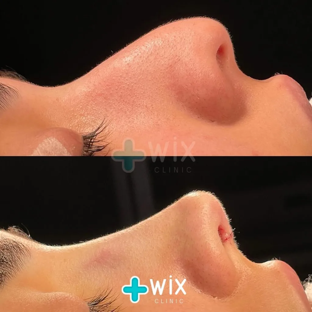 Rhinoplasty Before and After