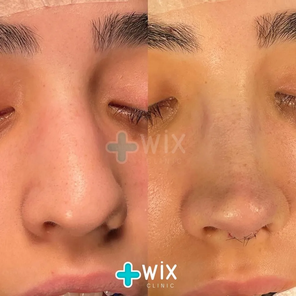 Rhinoplasty Before and After