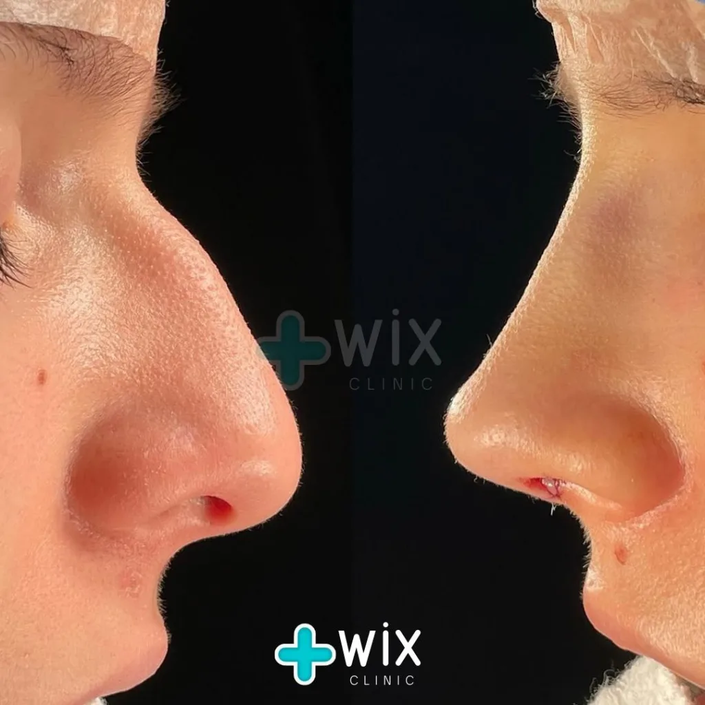 Rhinoplasty before and after