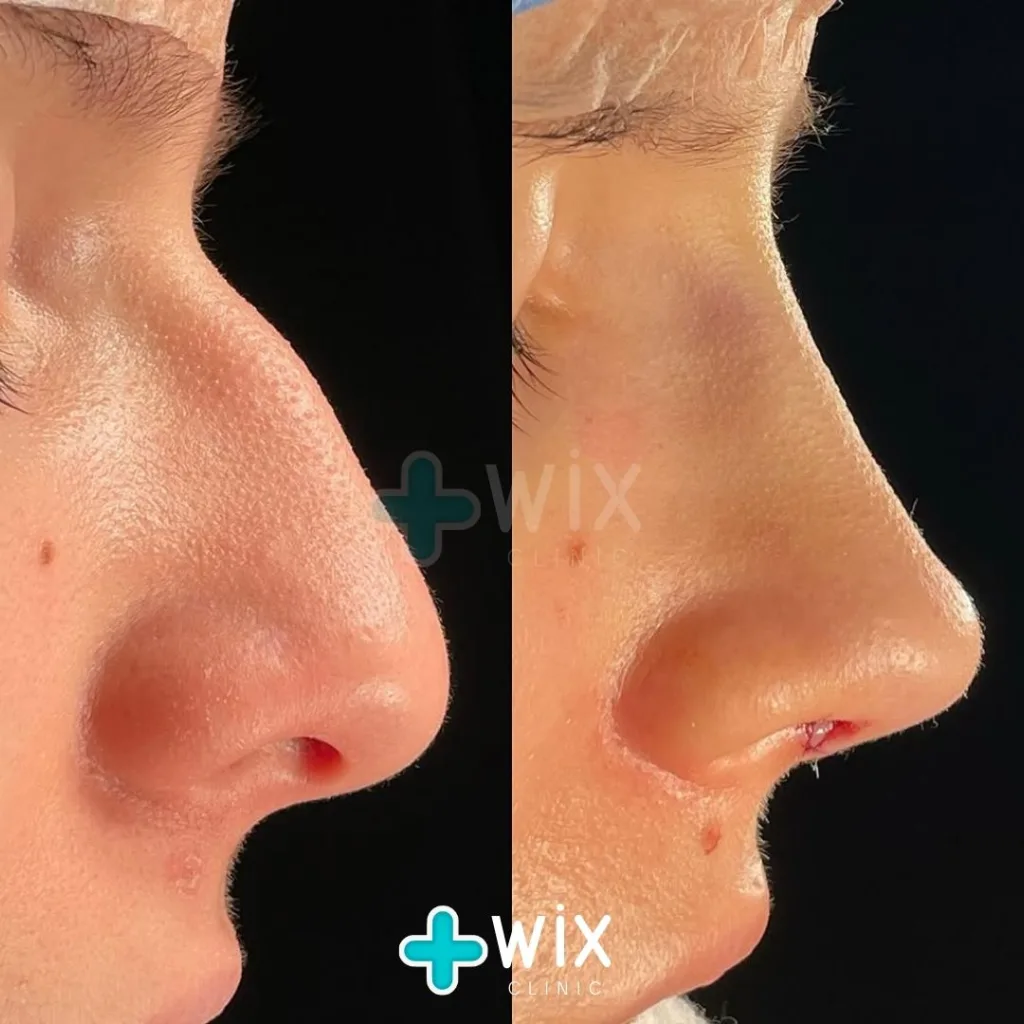 Rhinoplasty before and after