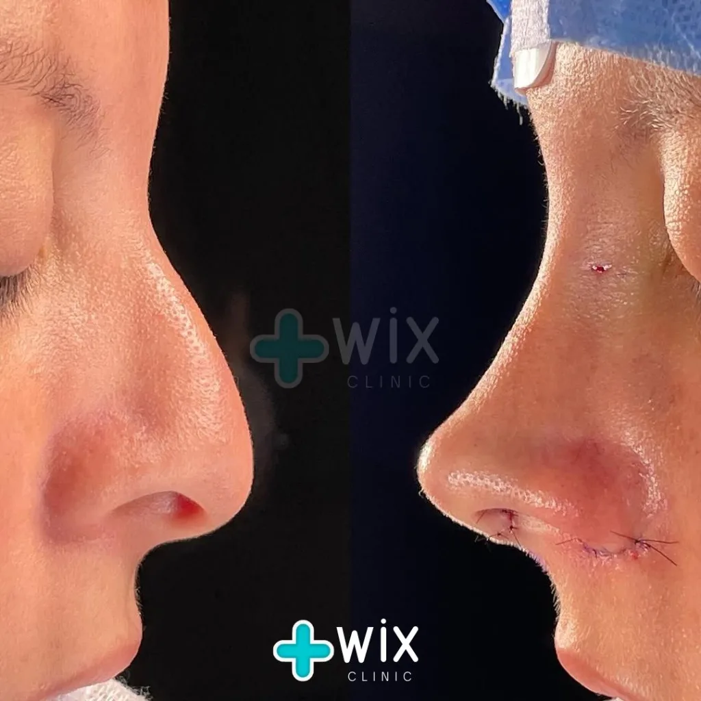 Rhinoplasty Before and After