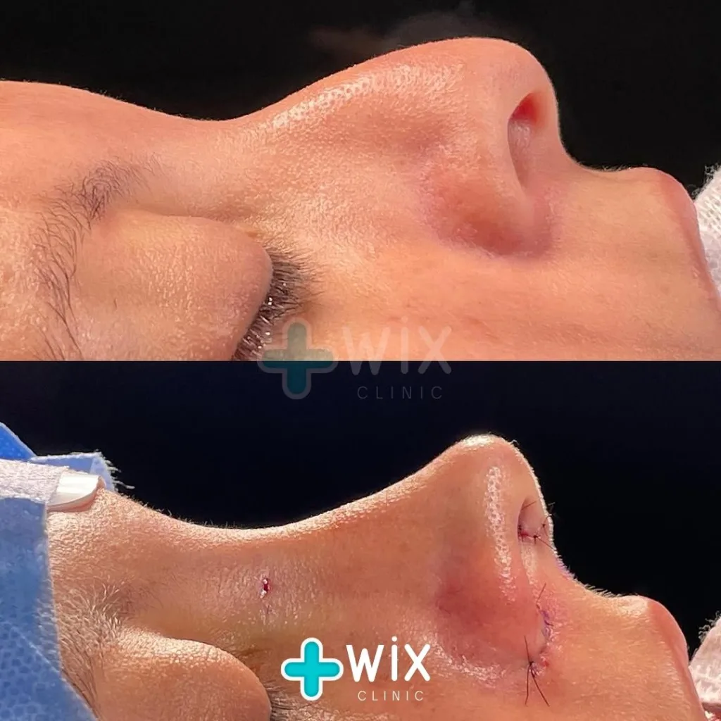 Rhinoplasty Before and After