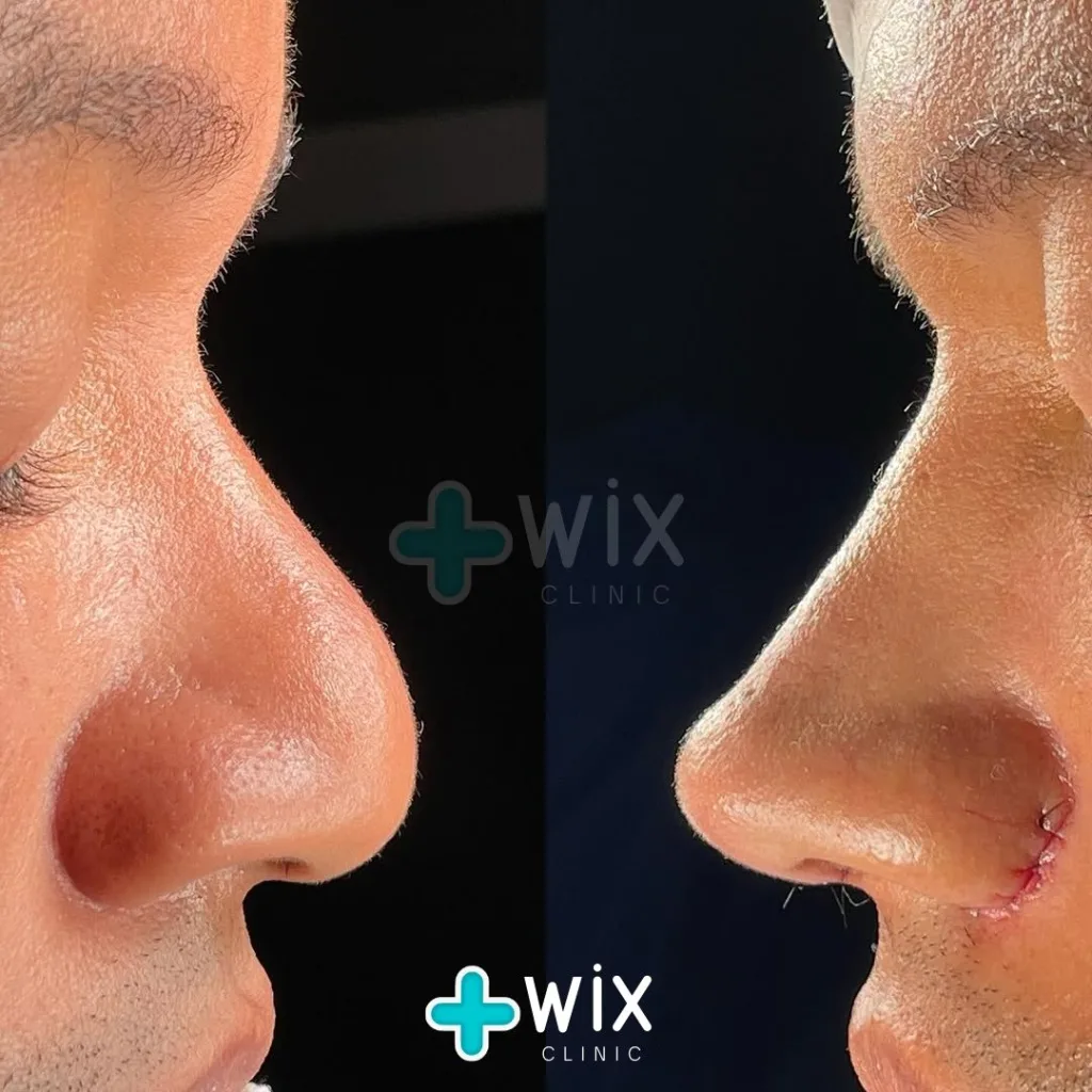 Rhinoplasty Before and After