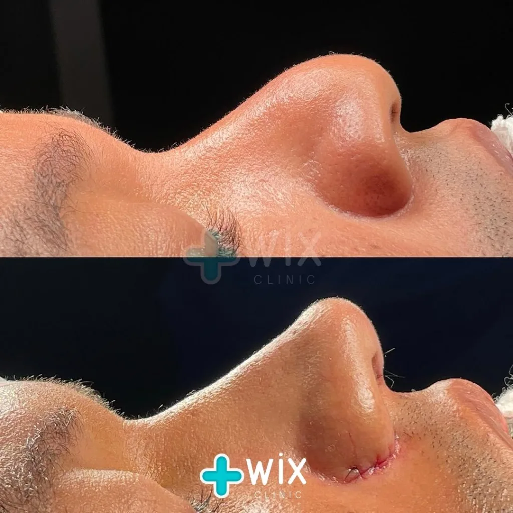 Rhinoplasty Before and After