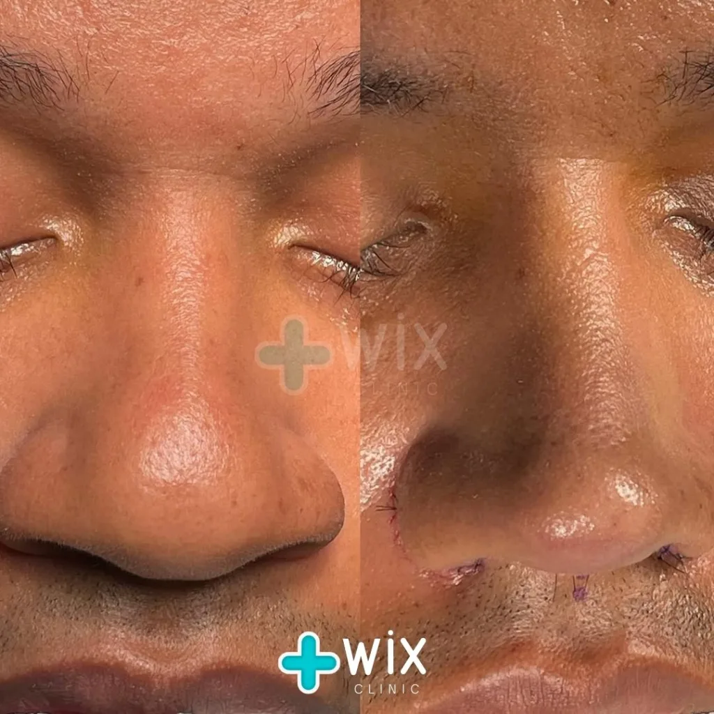 Rhinoplasty Before and After