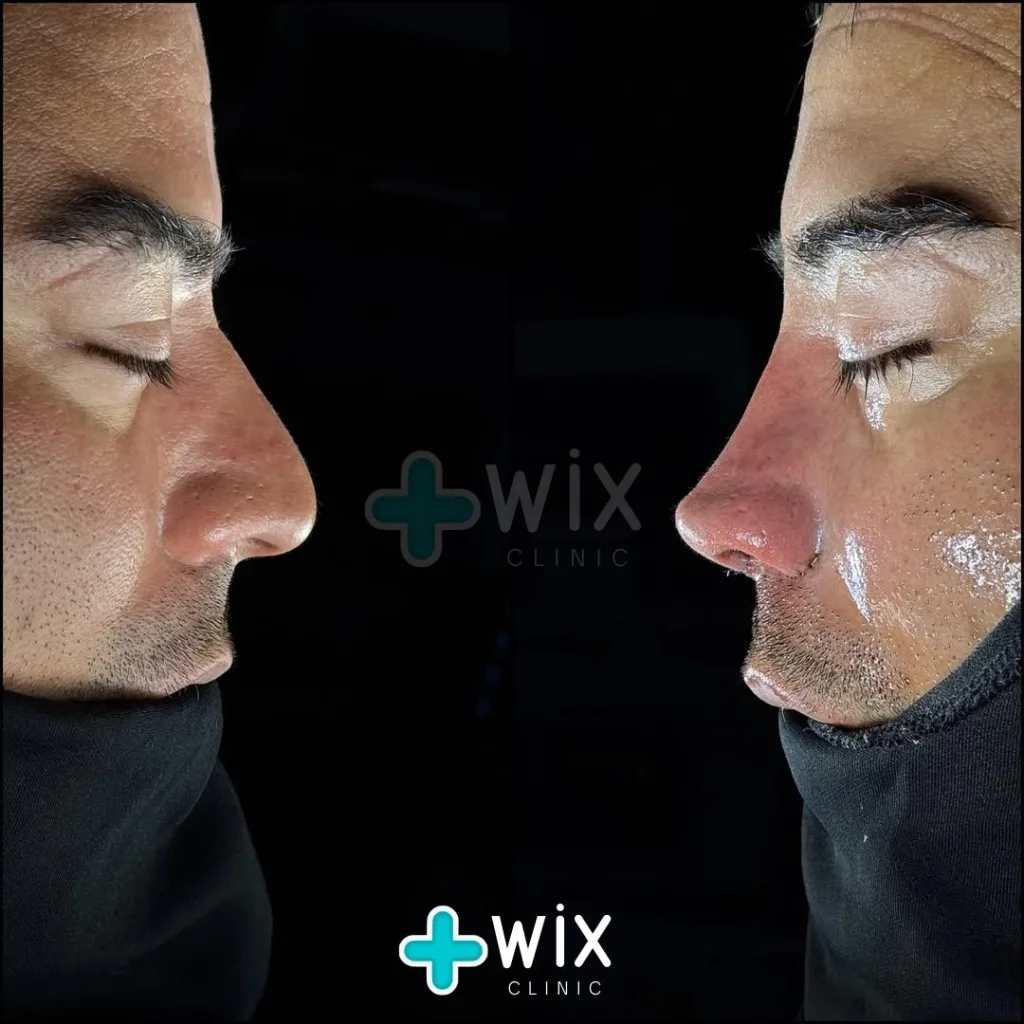 Rhinoplasty Before and After