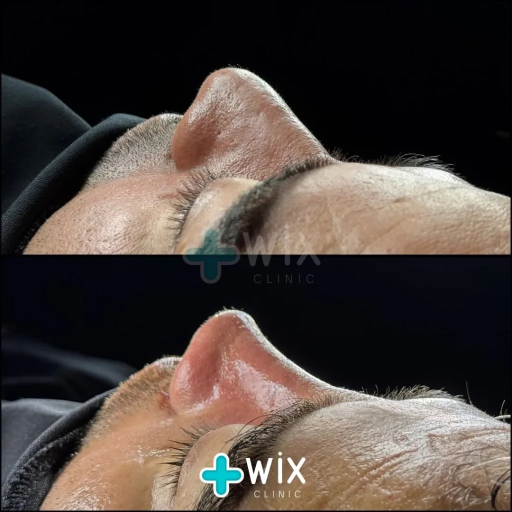 Rhinoplasty Before and After