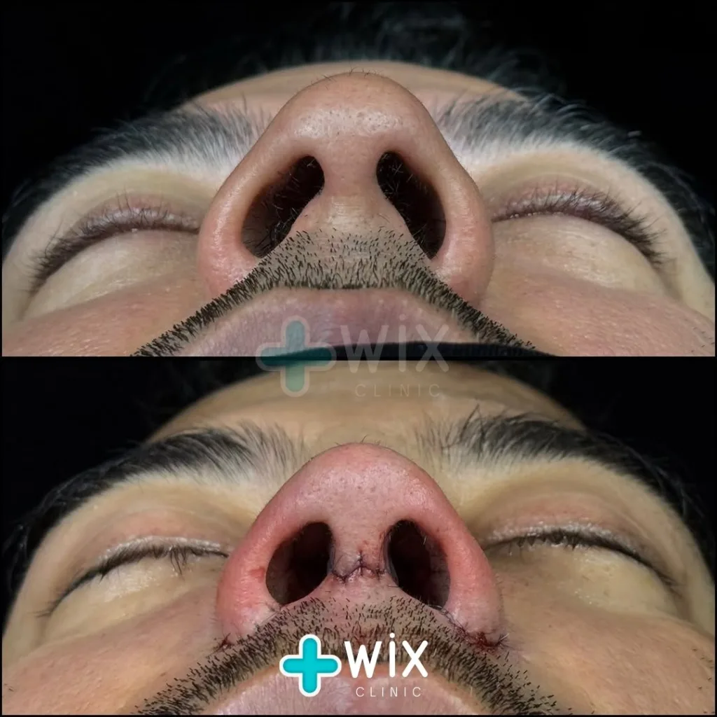 Rhinoplasty Before and After