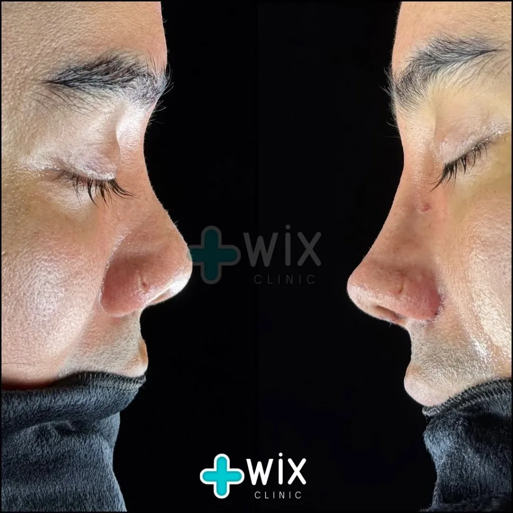 Rhinoplasty Before and After