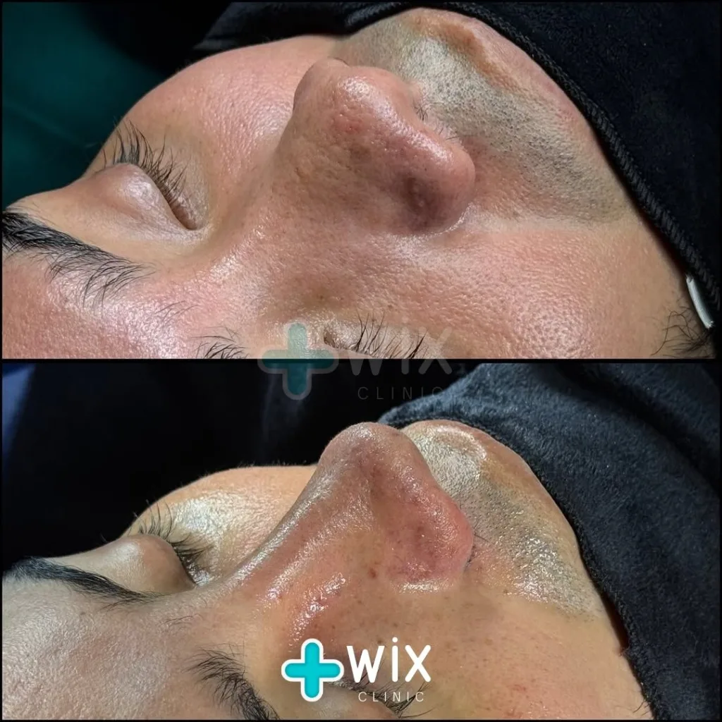 Rhinoplasty Before and After