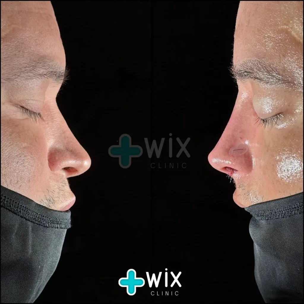 Rhinoplasty Before and After