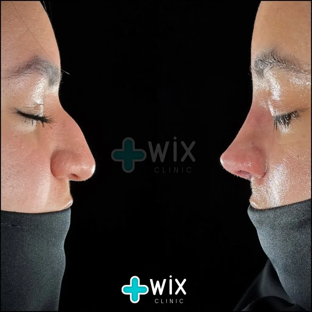 Rhinoplasty Before and After