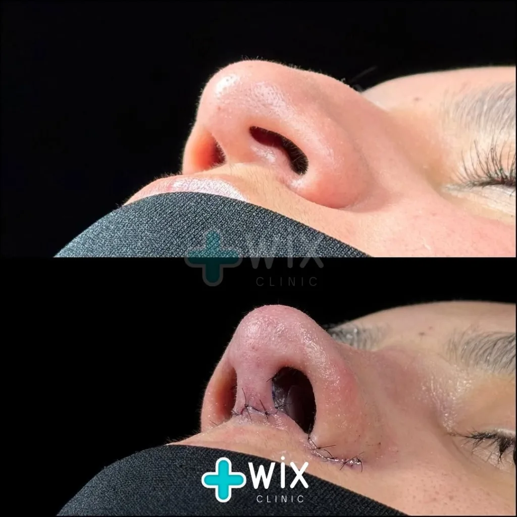 Rhinoplasty Before and After