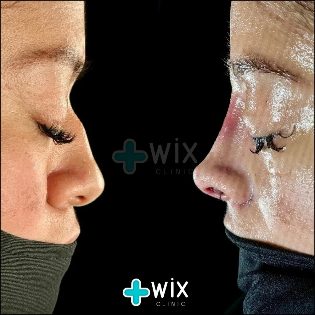 Rhinoplasty Before and After