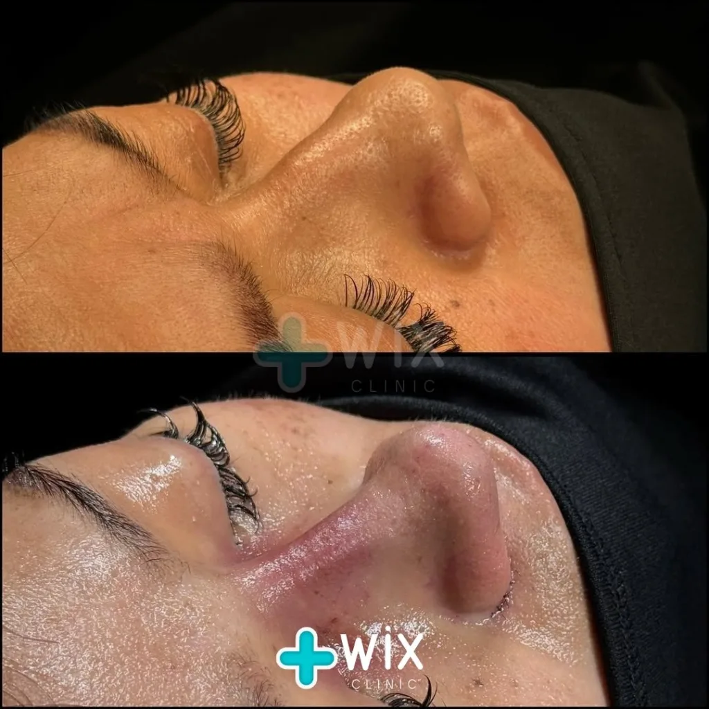 Rhinoplasty Before and After