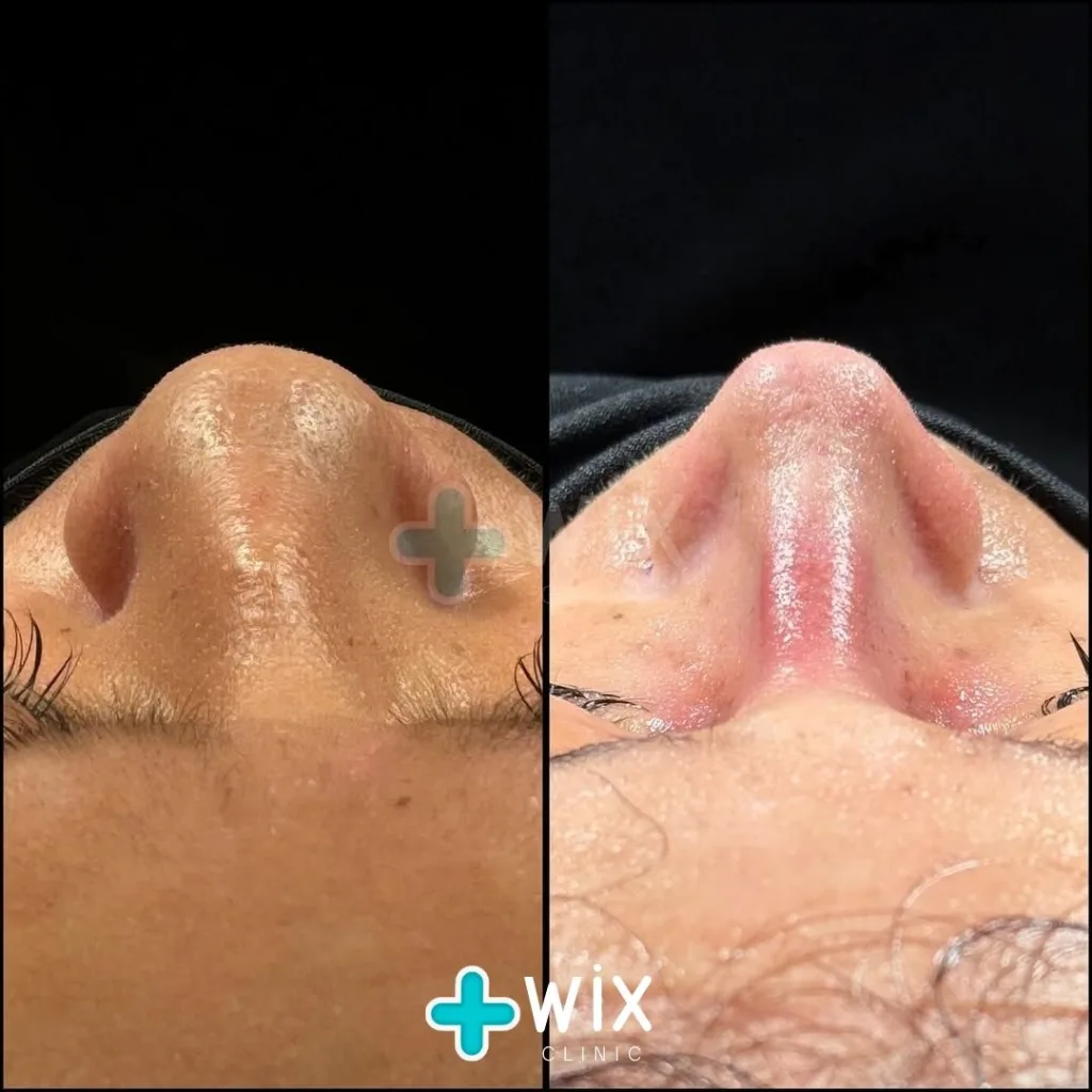 Rhinoplasty Before and After