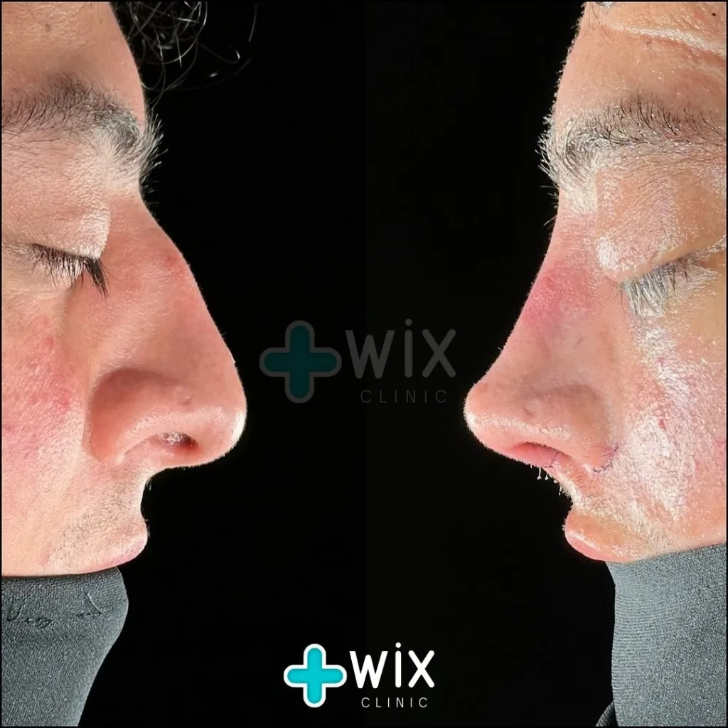 Rhinoplasty Before and After