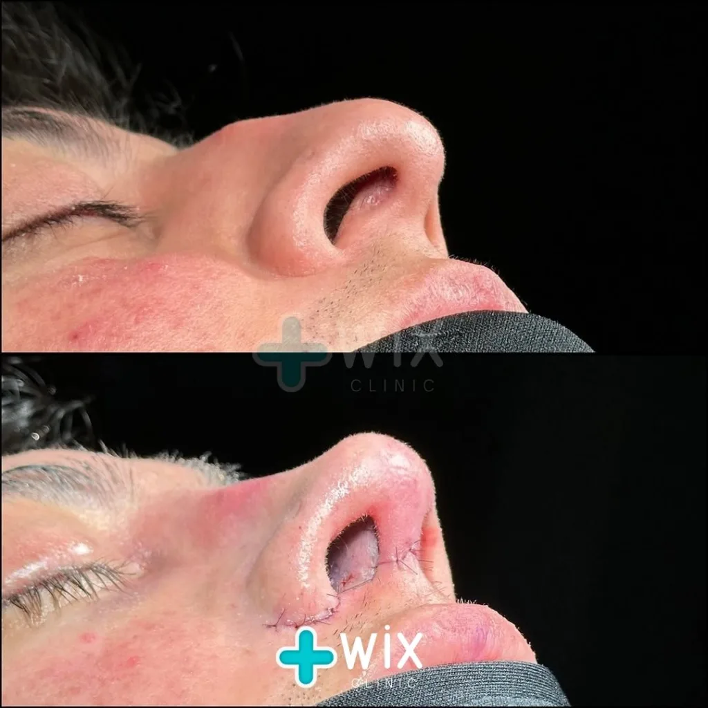 Rhinoplasty Before and After