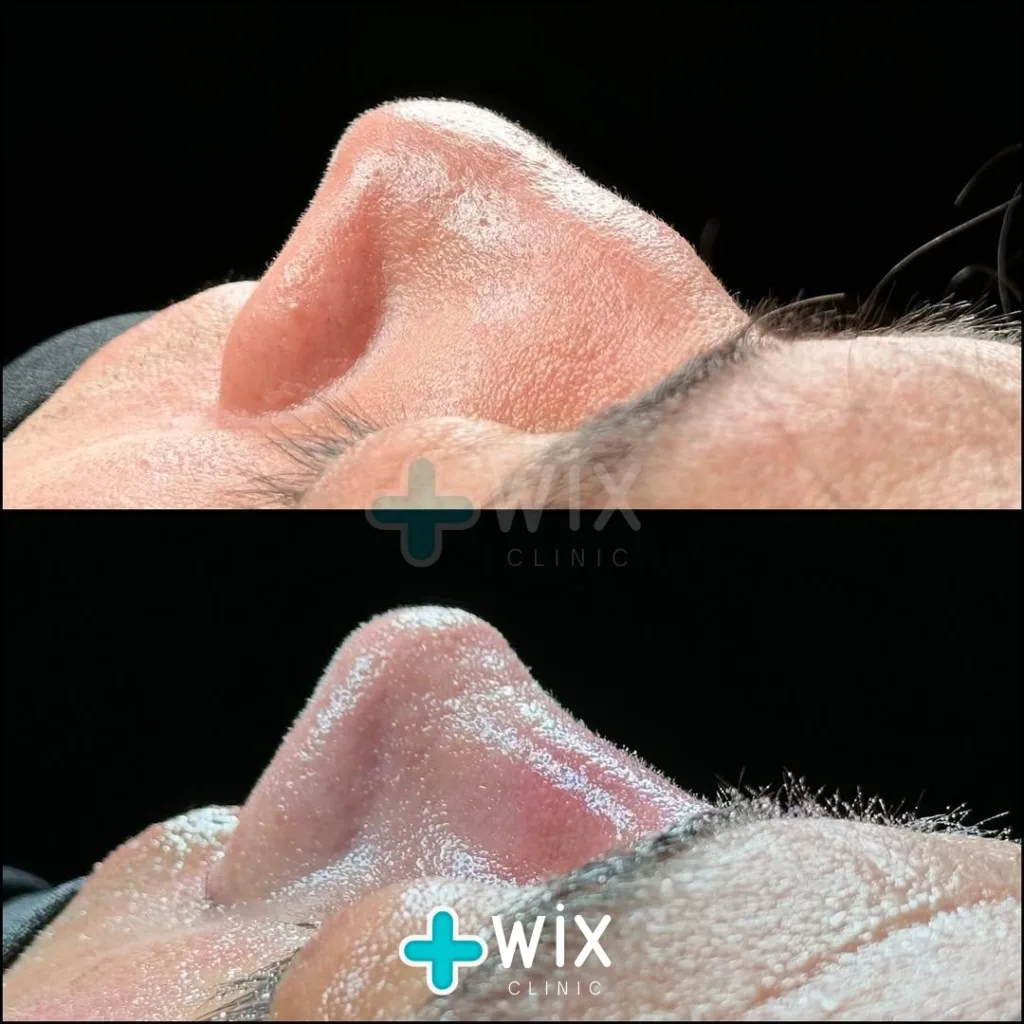 Rhinoplasty Before and After