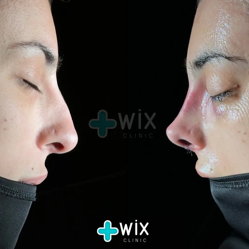 Rhinoplasty Before and After