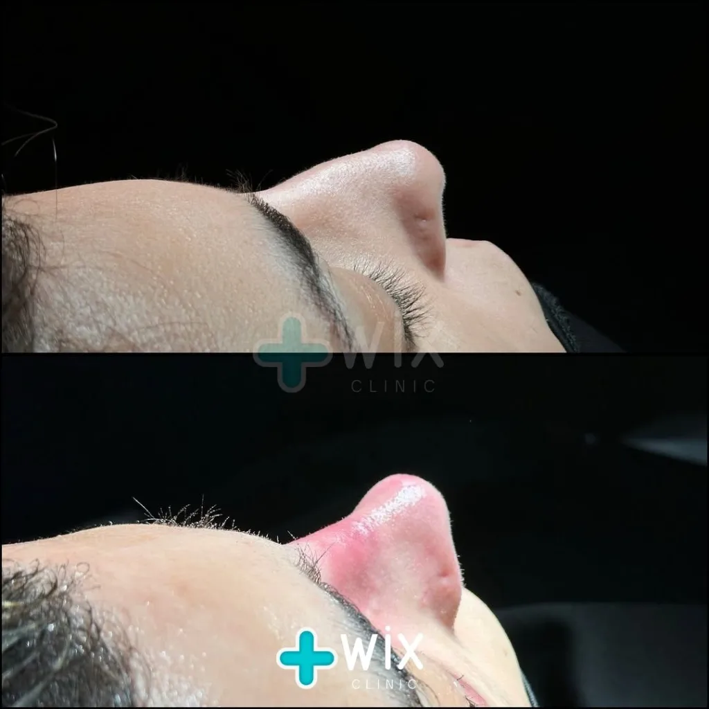 Rhinoplasty Before and After