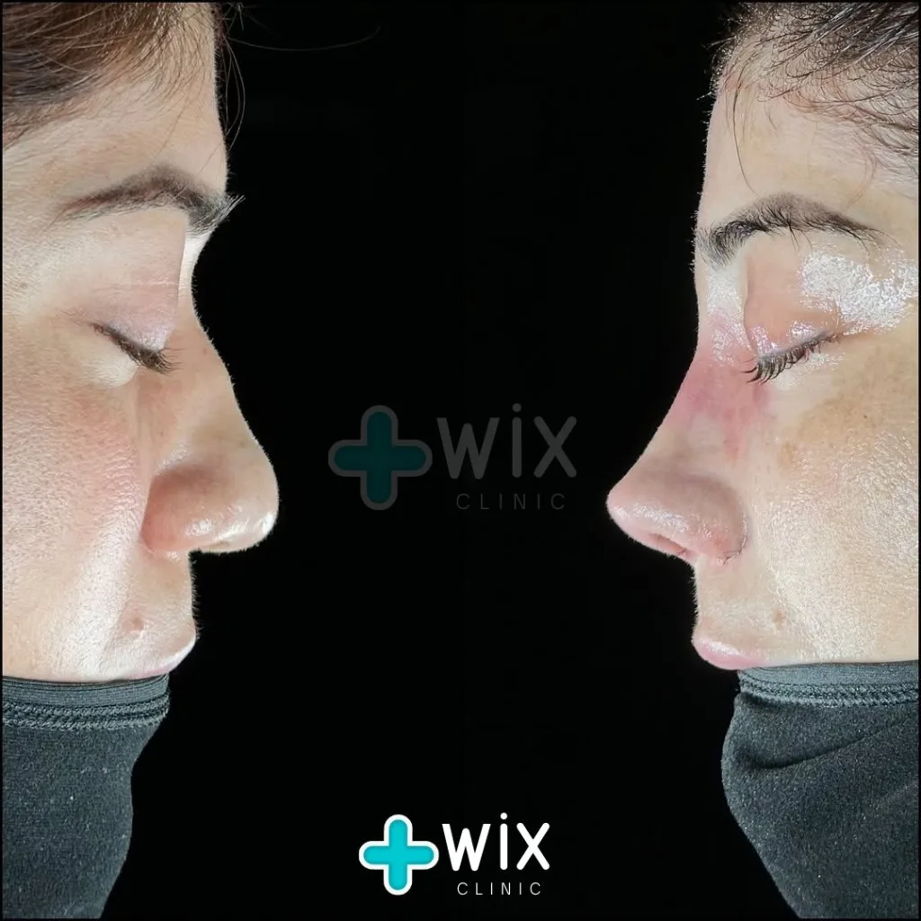 Rhinoplasty Before and After