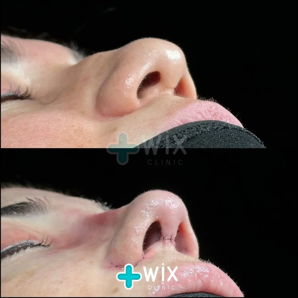 Rhinoplasty Before and After