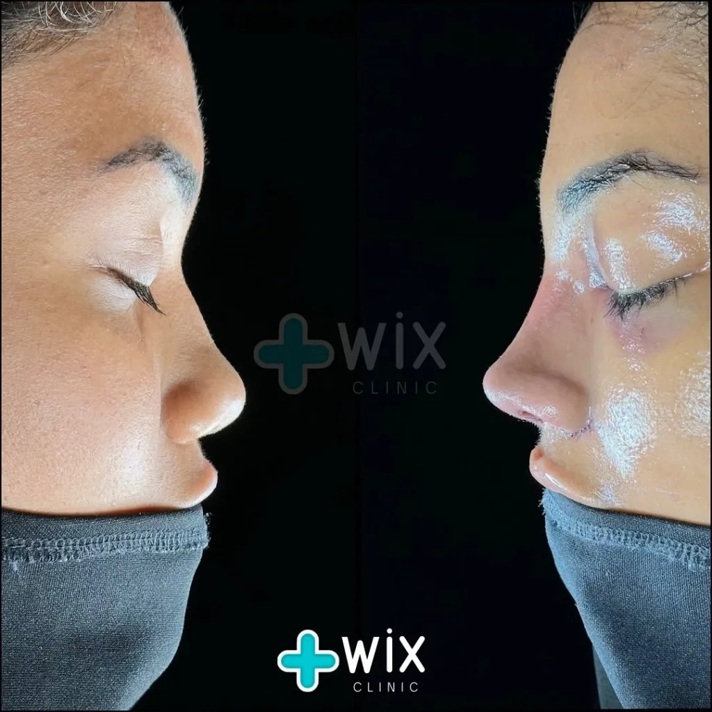 Rhinoplasty Before and After