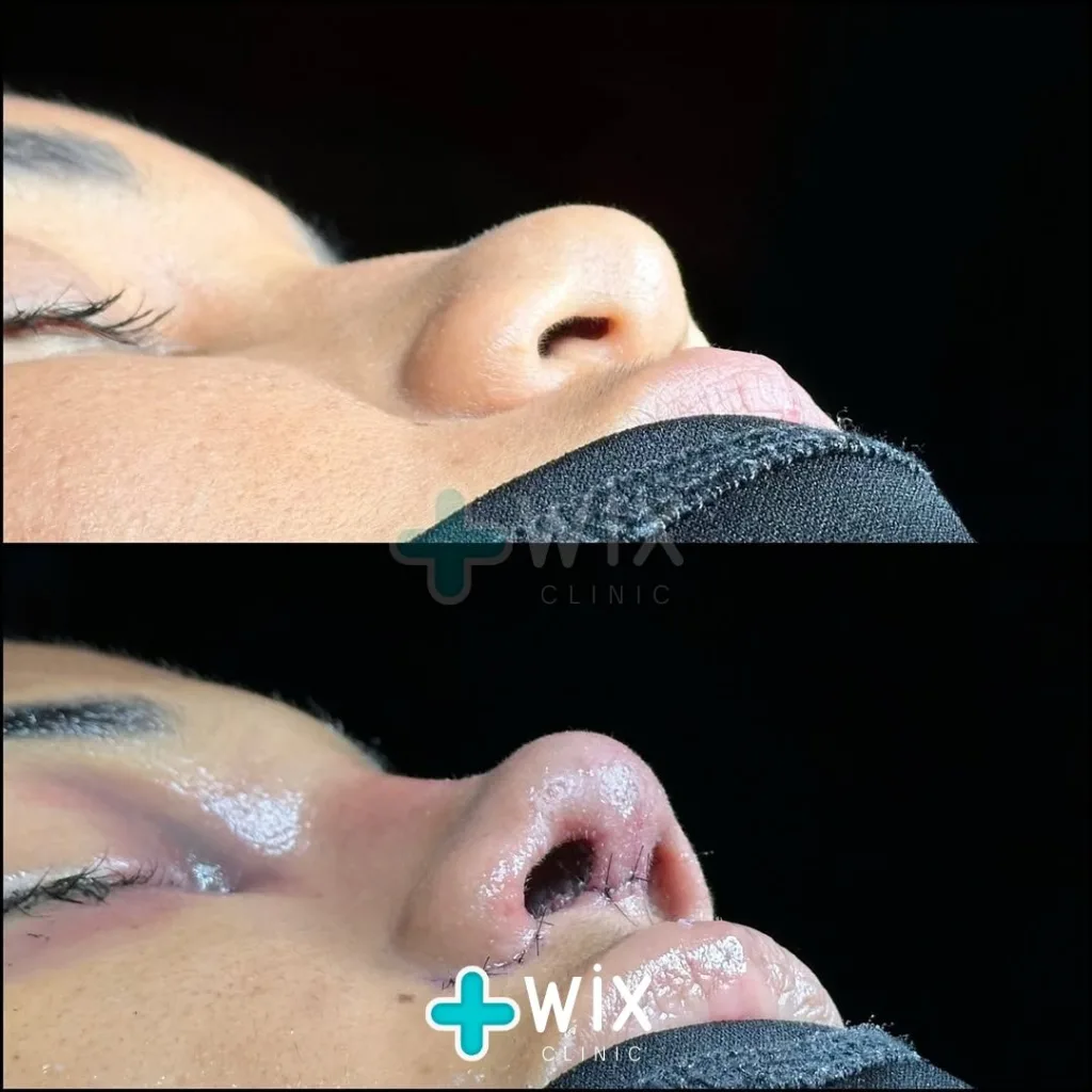 Rhinoplasty Before and After