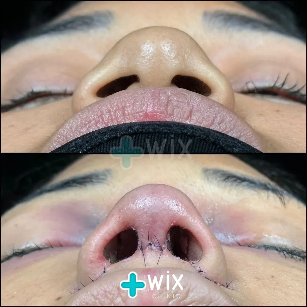 Rhinoplasty Before and After