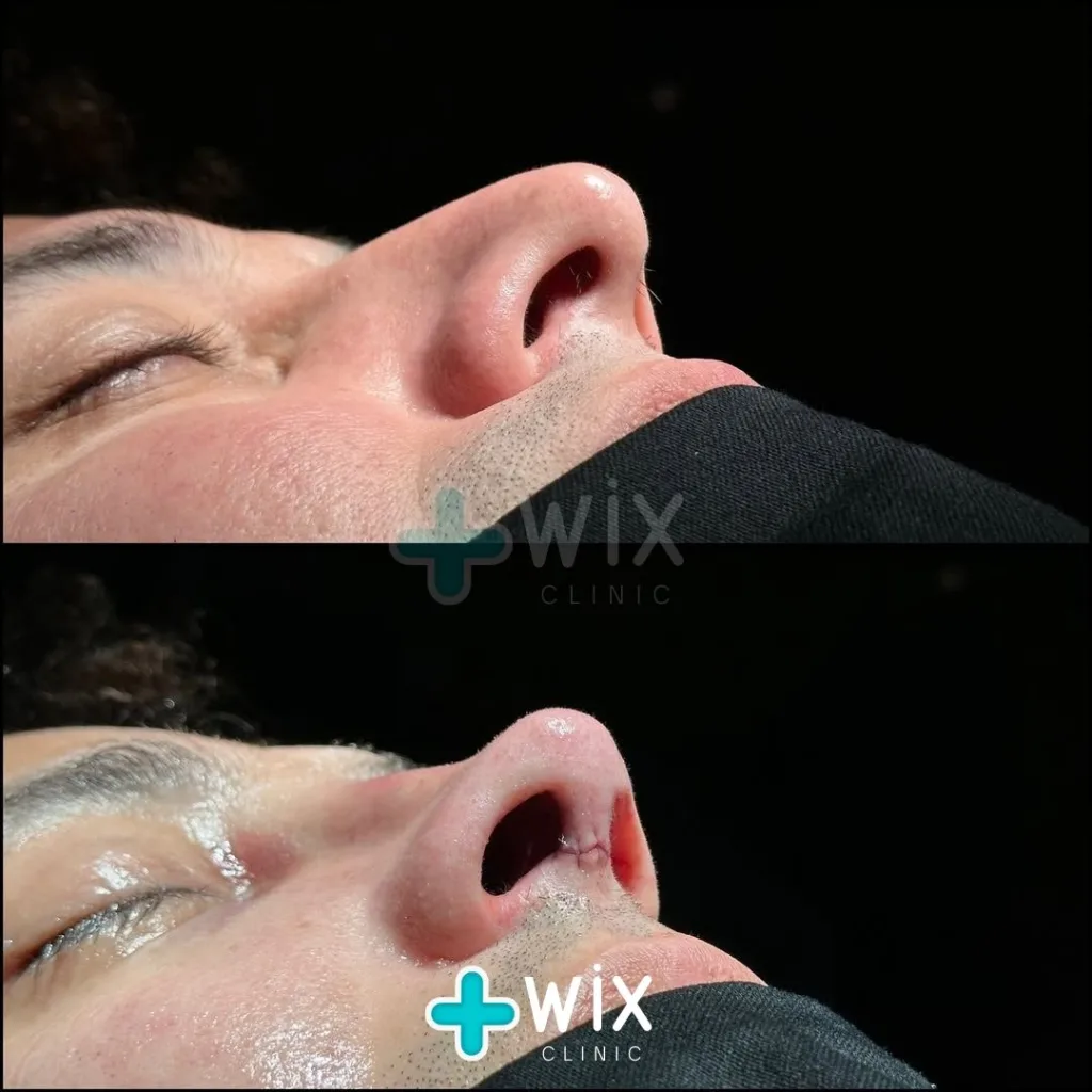 Rhinoplasty Before and After