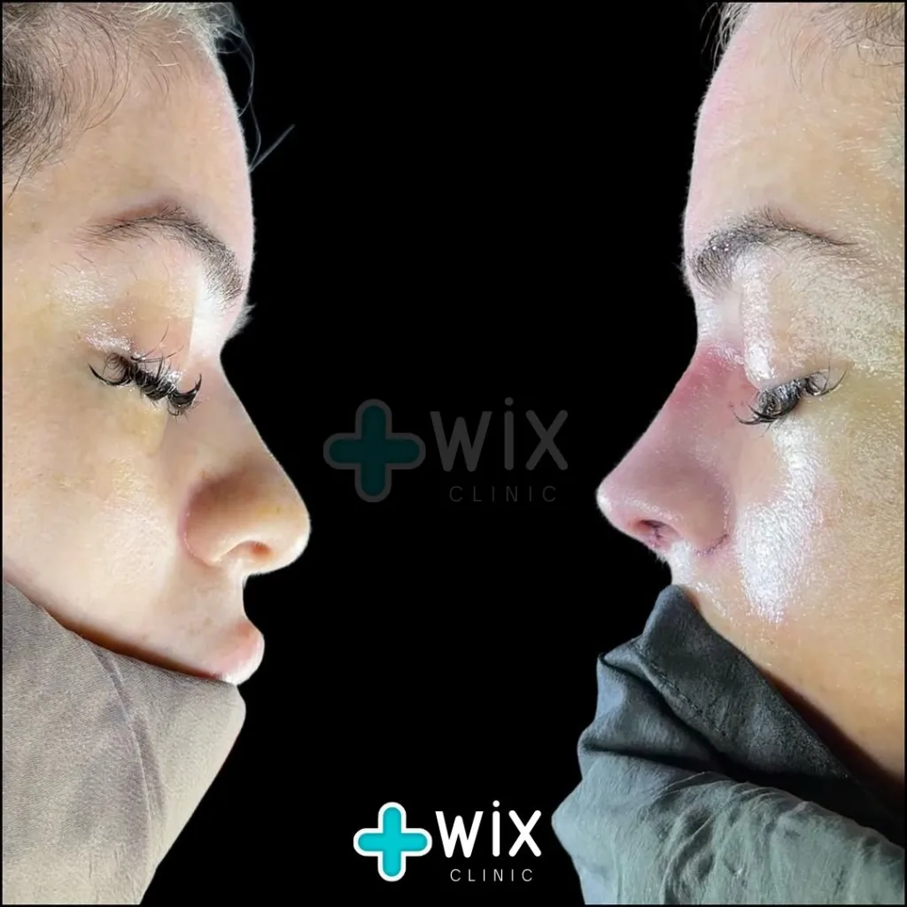 Rhinoplasty Before and After