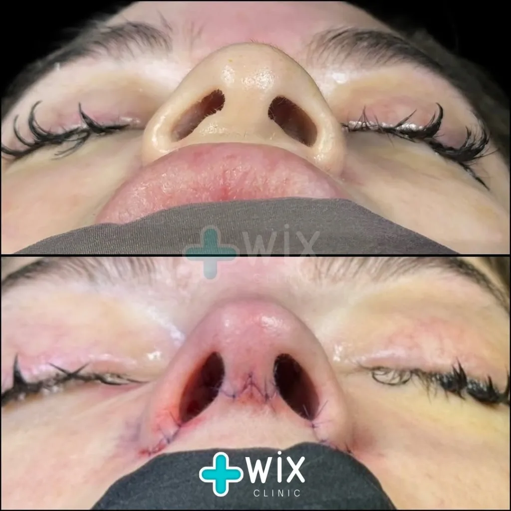 Rhinoplasty Before and After