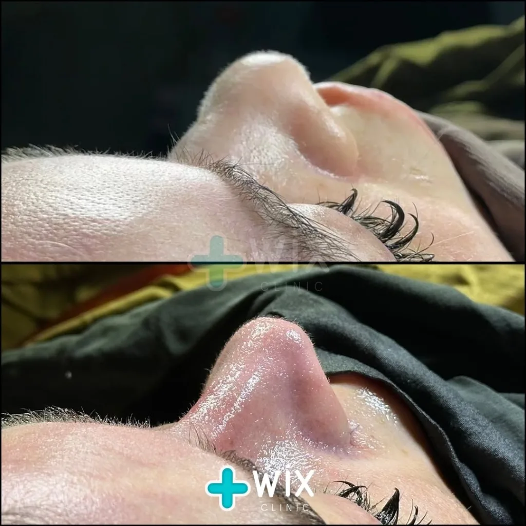 Rhinoplasty Before and After