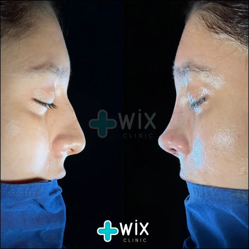 Rhinoplasty Before and After