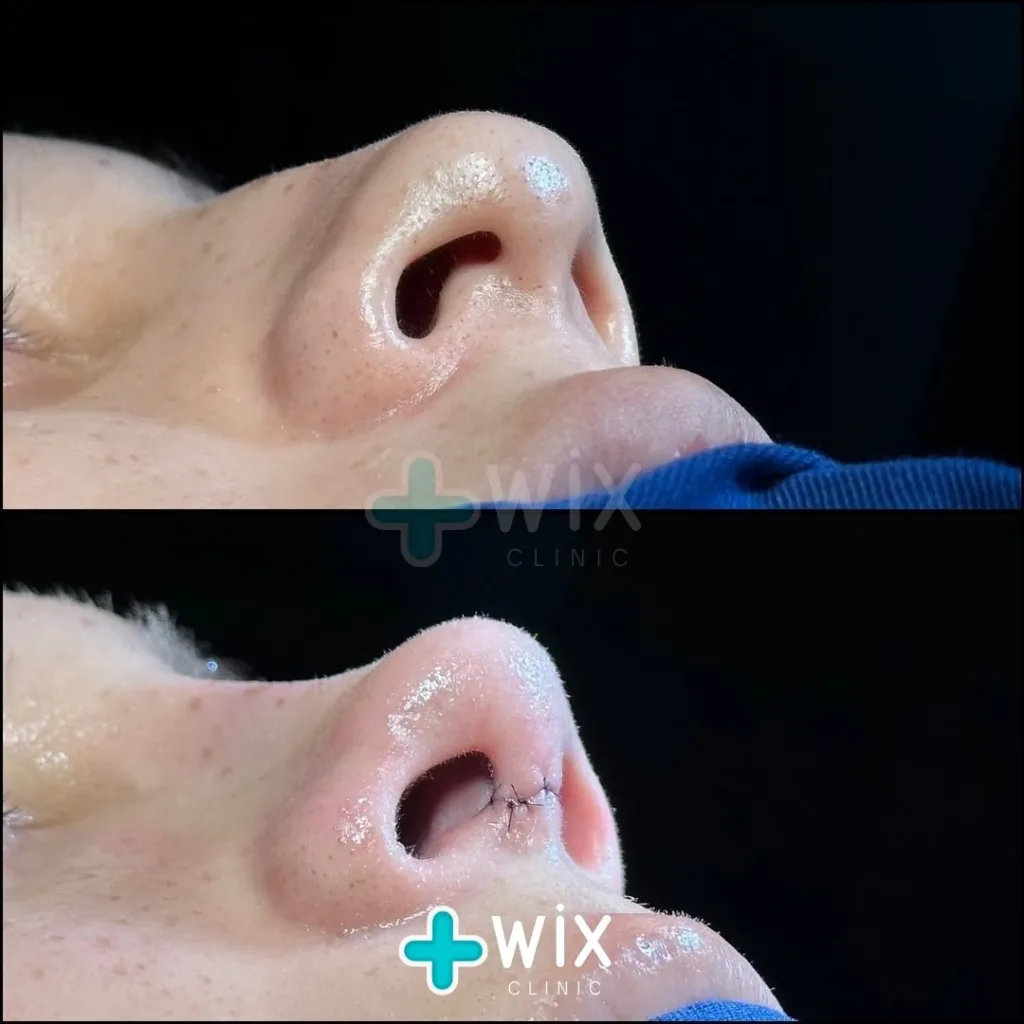 Rhinoplasty Before and After