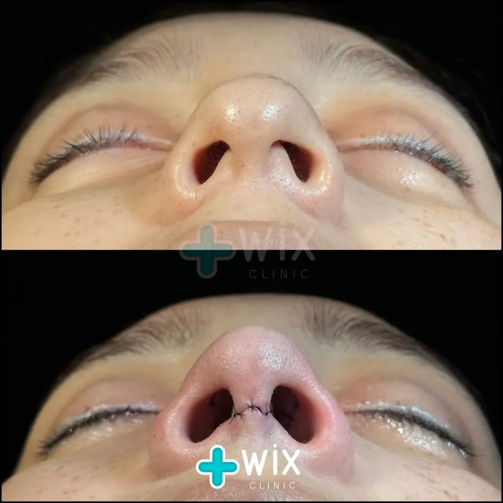 Rhinoplasty Before and After