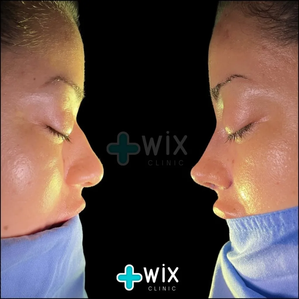 Rhinoplasty Before and After