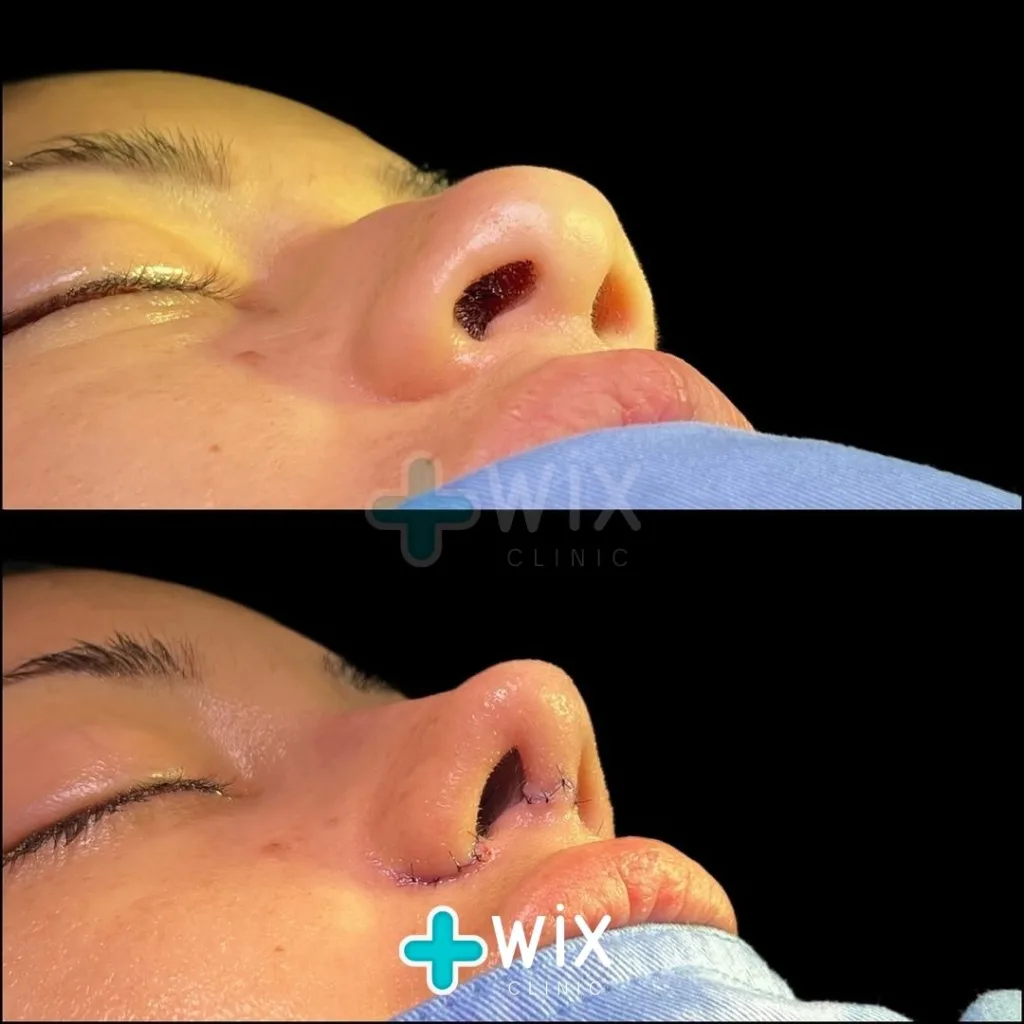 Rhinoplasty Before and After